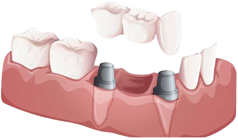 Replace Missing Teeth