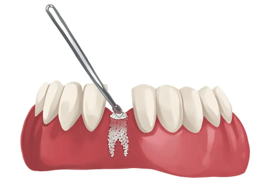 What is an Implant
