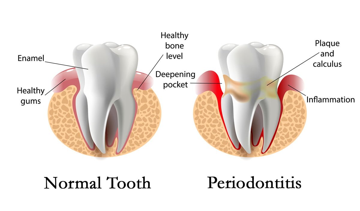 gum-disease-peiodoniti