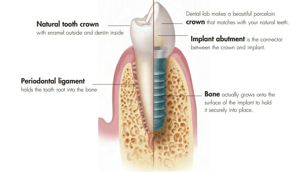 tooth_vs_implants